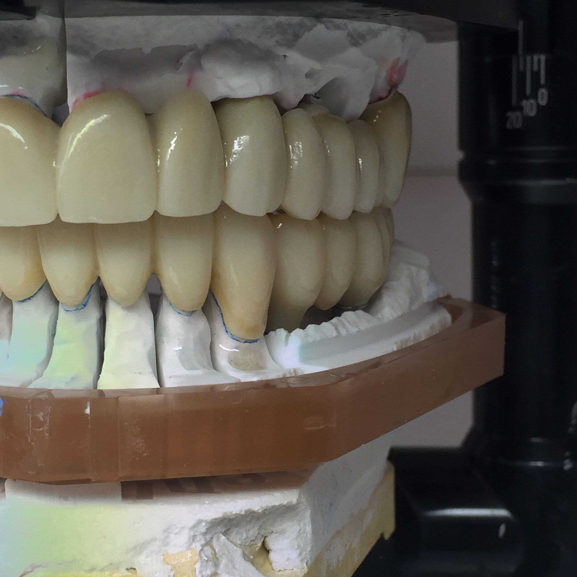 Prótesis dental en articulador para control de oclusión y estética